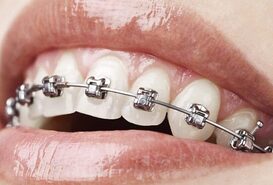 Imagen de Brackets Autoligado