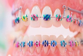 Imagen de Brackets Infantiles