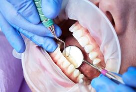 Imagen de Tratamiento de Caries