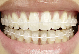 Imagen de Brackets Estéticos