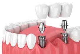 Imagen de Implantes de Carga Inmediata