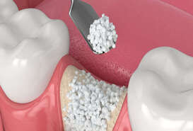 Imagen de Injerto de Hueso