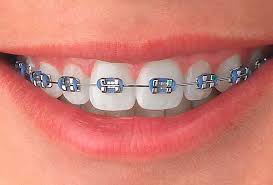 Imagen de Brackets Metálicos Convencionales