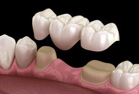 Imagen de Prótesis Dental Fija