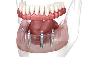 Imagen de Prótesis sobre Implantes